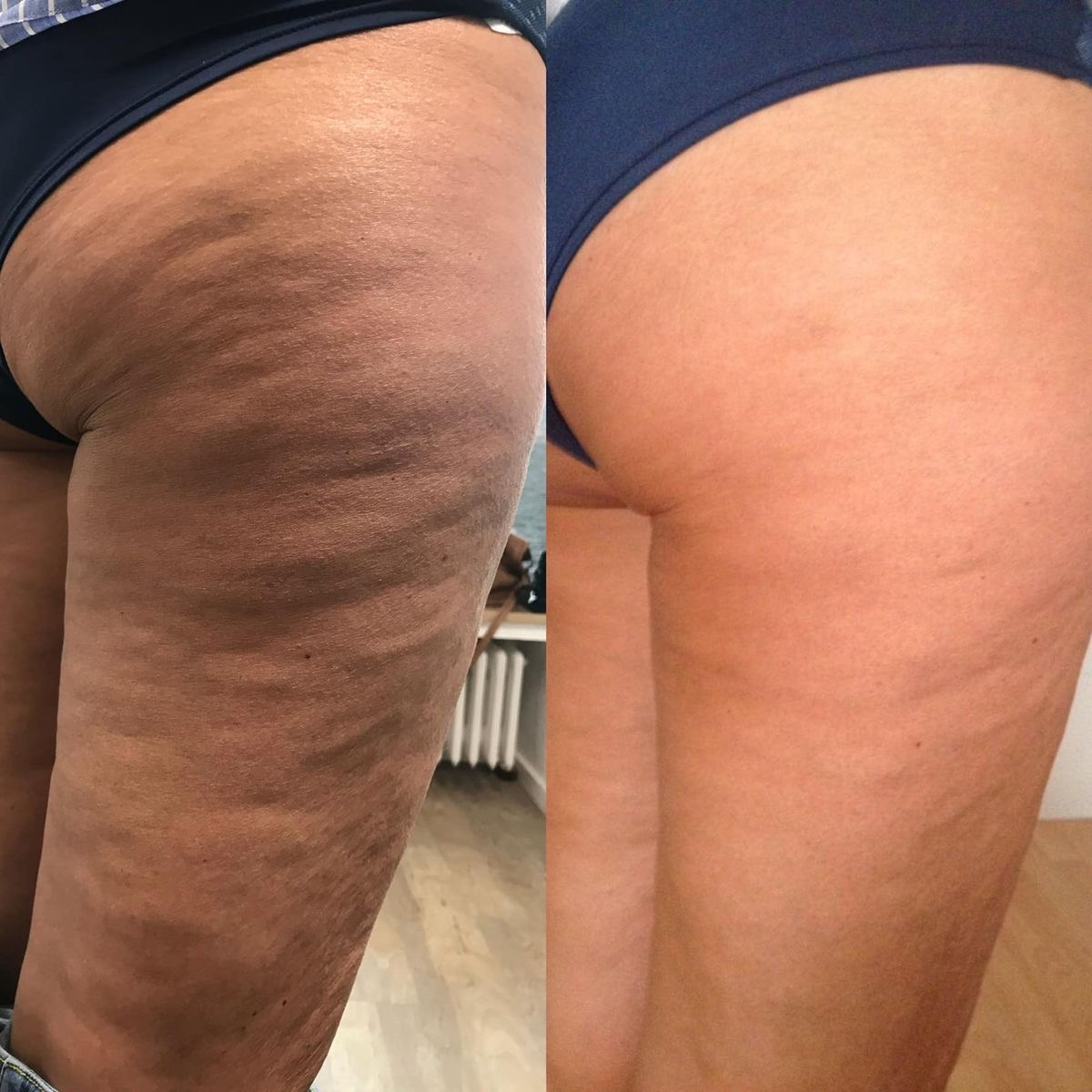 Resultado antes e depois — protocolo corporal de firmeza