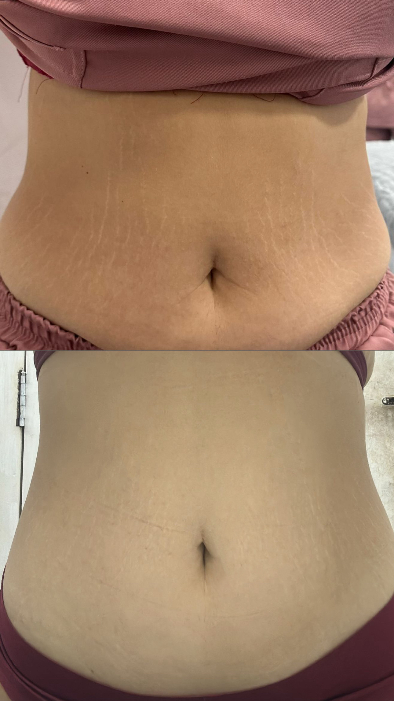 Resultado antes e depois — protocolo de qualidade da pele