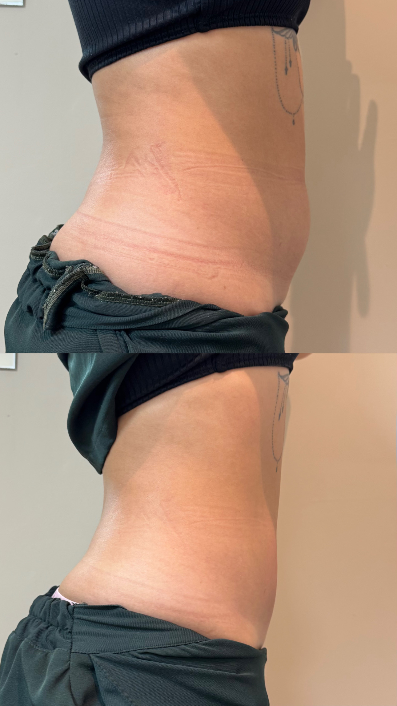 Resultado antes e depois — recuperação da pele
