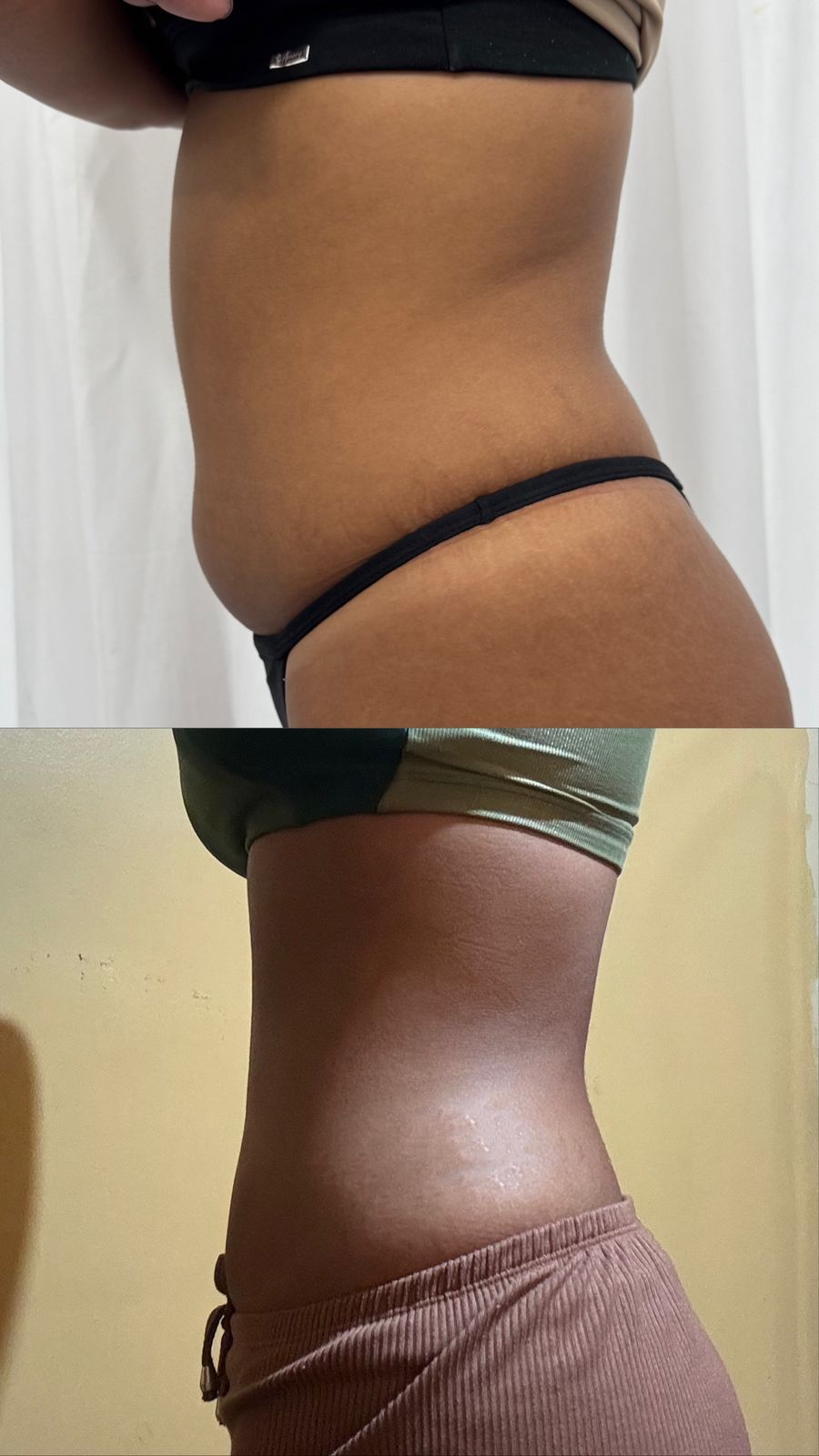 Resultado antes e depois — protocolo corporal